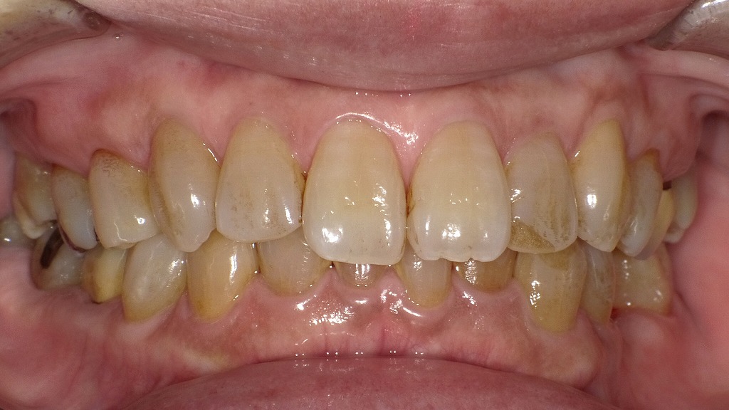 軽度の着色(ステイン)症例