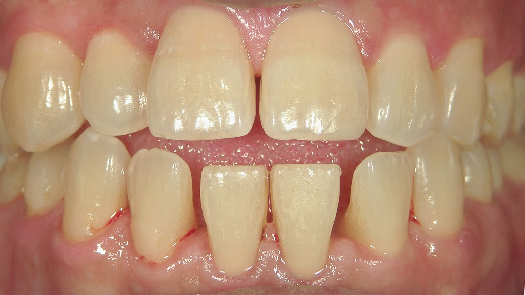 大人の開咬症例：術前