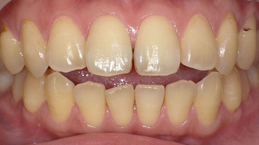 1枚目（ホワイトニング前）