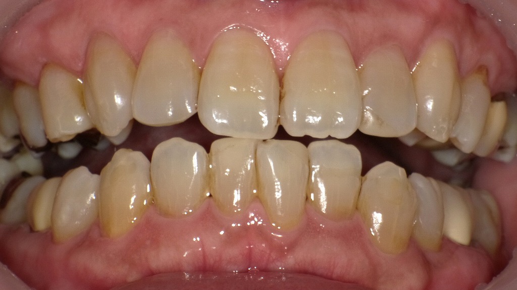 エアフローにてステインを除去