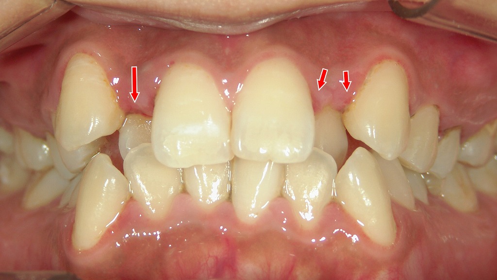 歯が重なって磨き残しが増えると、歯ぐきが腫れやすく歯肉炎を発症します。
さらに歯石の沈着や虫歯、歯周病リスクも高まるため、早めの対策が大切です。