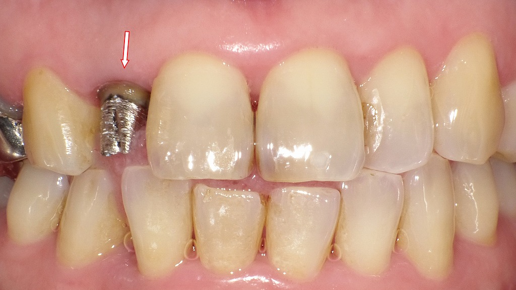 右上2番（上顎側切歯）に装着されているメタルコア（金属製の支台）
