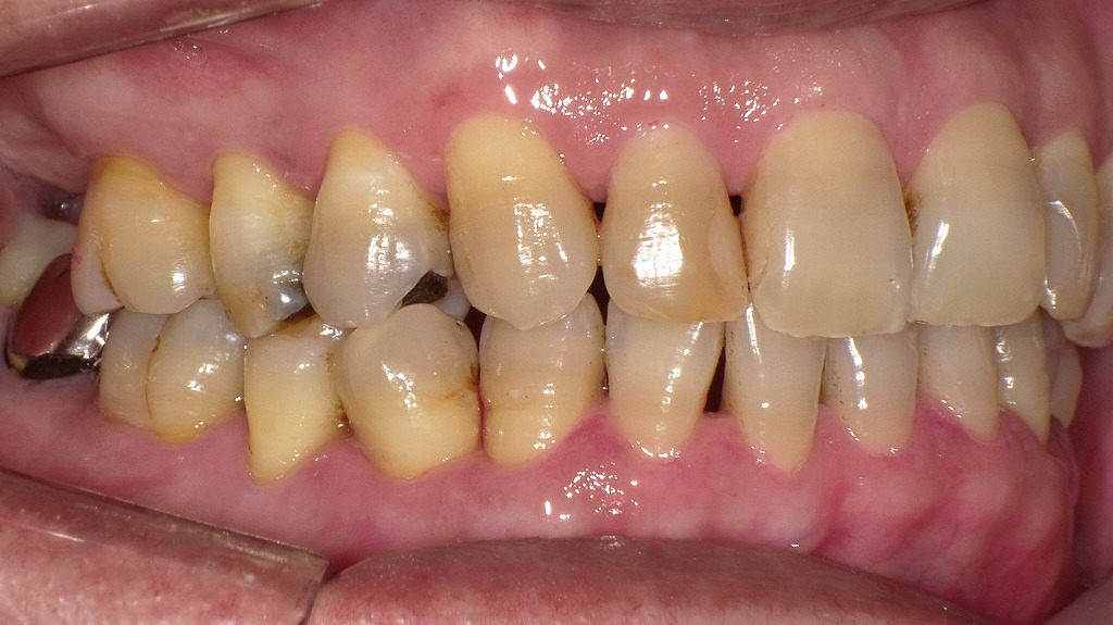 術後:歯周病に罹患している症例
