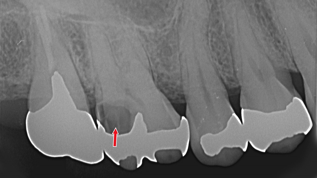 銀歯の下に神経に近い虫歯