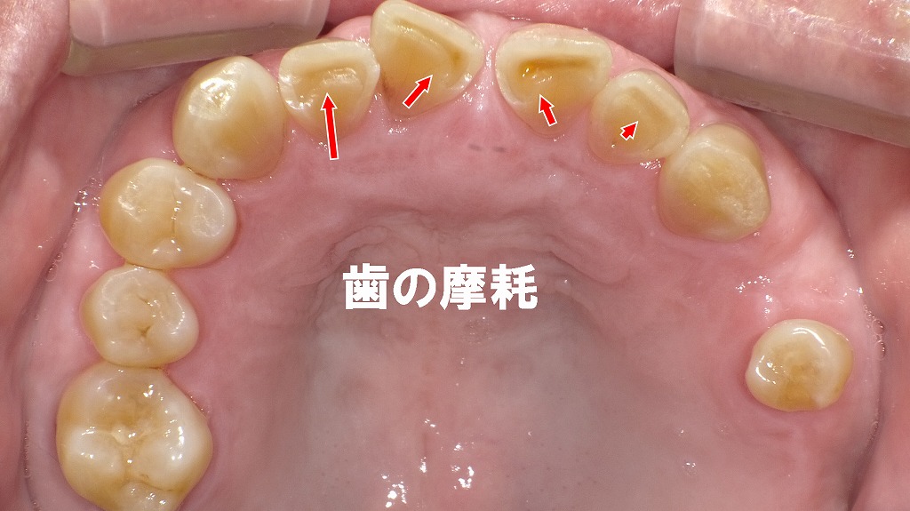 睡眠時の歯ぎしり・食いしばりで歯がすり減った状態（矢印部）。ナイトガードを装着することで、これ以上の摩耗を防ぐことができます。