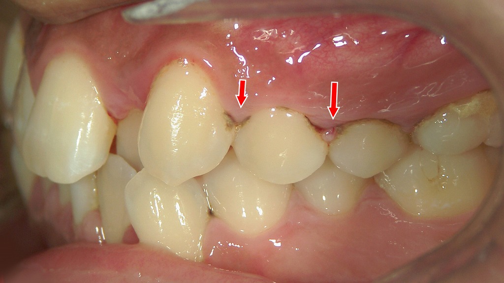 歯石による炎症で歯ぐきが赤く腫れ、出血を起こしている状態。歯周病サインです。