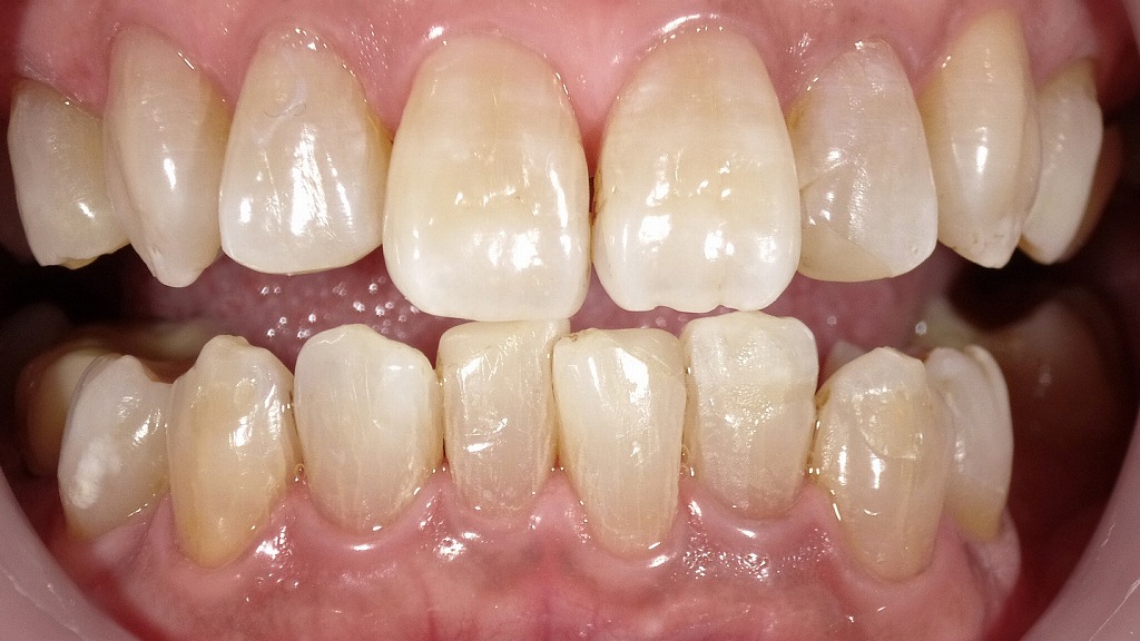 オフィスホワイトニング