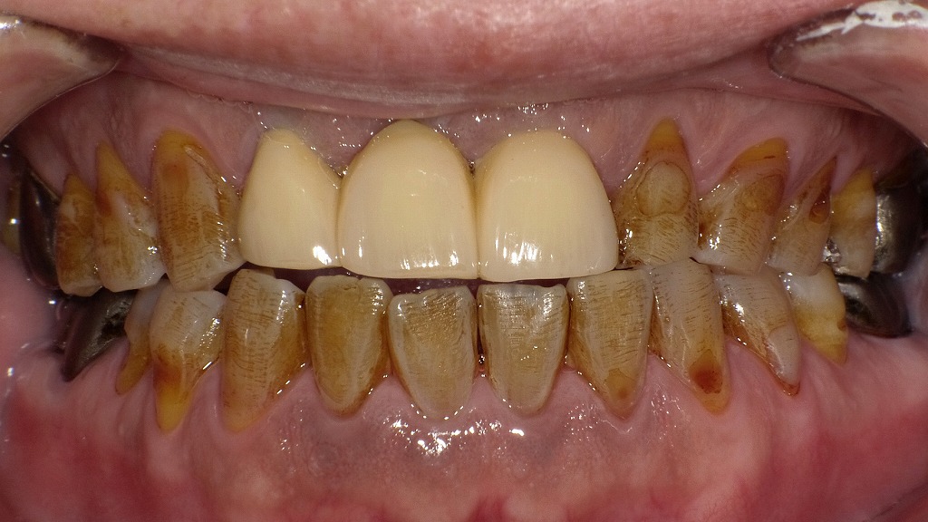 術前:強い着色(ステイン)