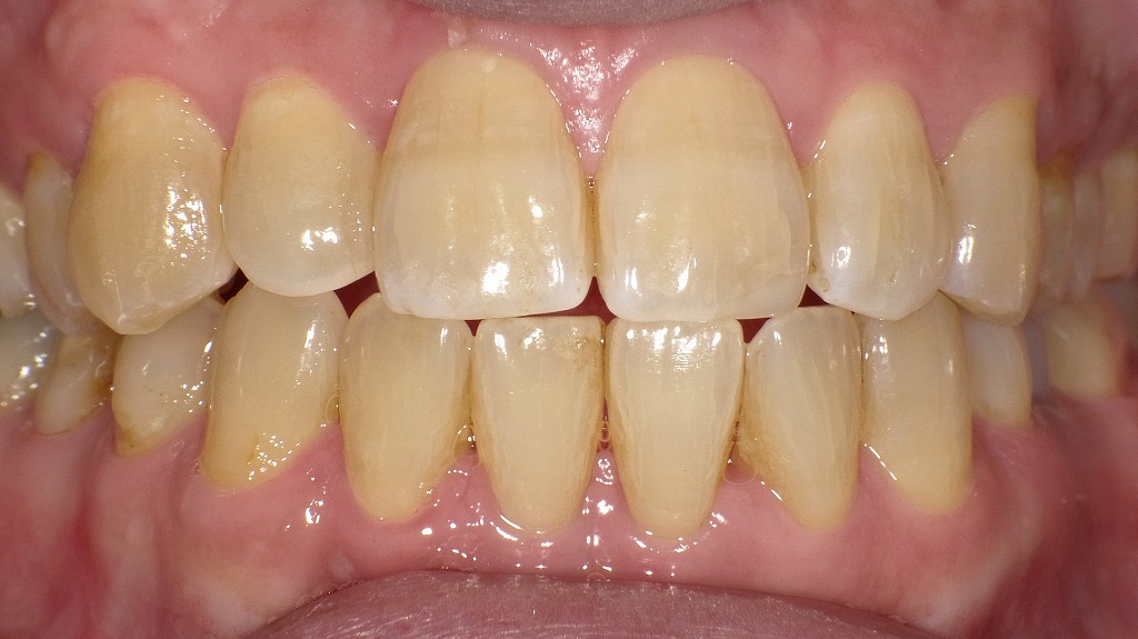 大人の開咬症例：術後