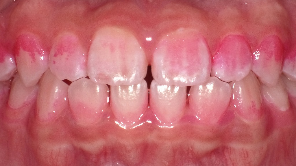 1年後のプラークコントロール改善：磨き残しの大幅減少