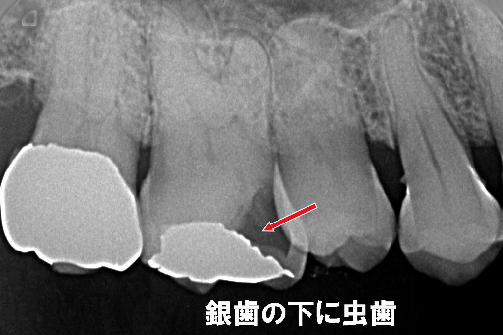 治療後に銀歯がしみる理由:銀歯の下で進行する“二次カリエス”
