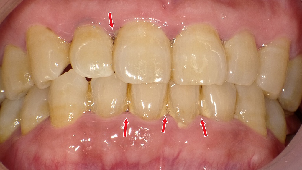歯周病が進行した口腔内:歯石の蓄積と歯肉炎が招く“歯の喪失リスク”