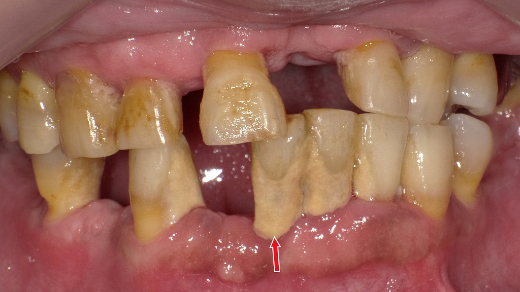 ステインと歯石が強く付着した状態。
プロのクリーニングで白さを取り戻しつつ、右下1番は重度歯周病のため抜歯が必要なケースです。