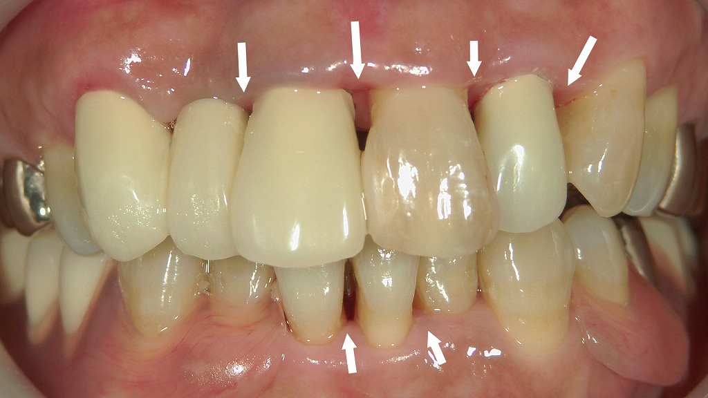 歯石除去と歯周治療の後、前歯部の補綴を再製作。歯ぐきの炎症が改善し、自然で清潔感のある前歯に回復。