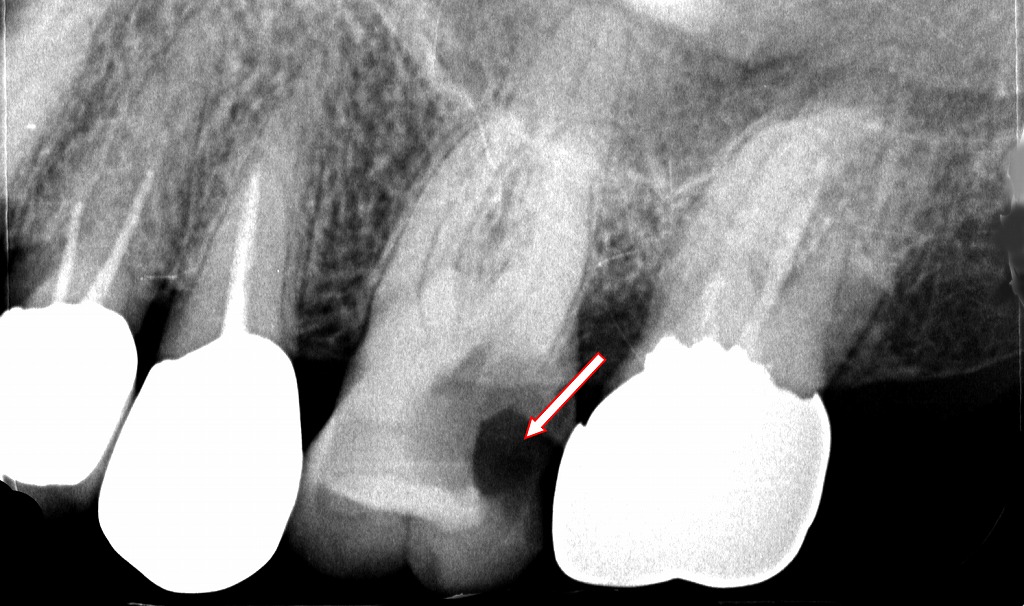 虫歯が原因の頭痛の典型例