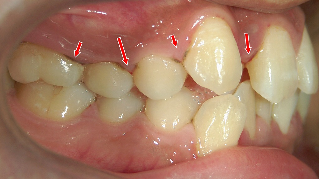 重なった歯のすき間に溜まる汚れを、ワンタフトでピンポイント清掃。