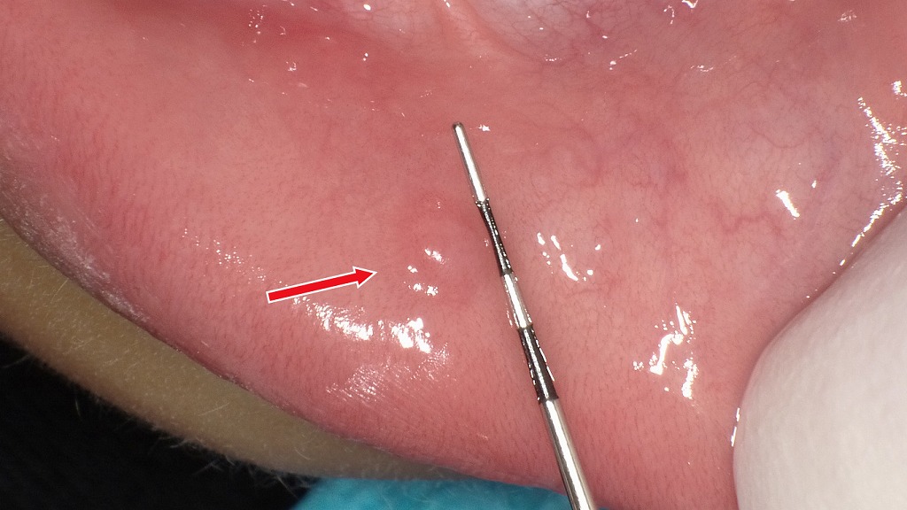 唇に出来た粘液嚢胞