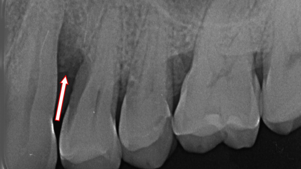上顎3番遠心部に、垂直性の骨吸収(垂直性骨欠損)