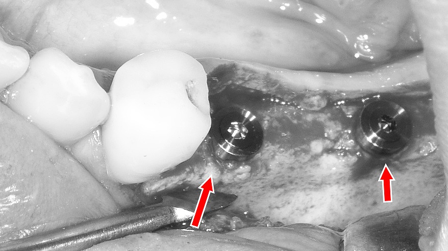 6番・7番相当部へのインプラント埋入の術中所見