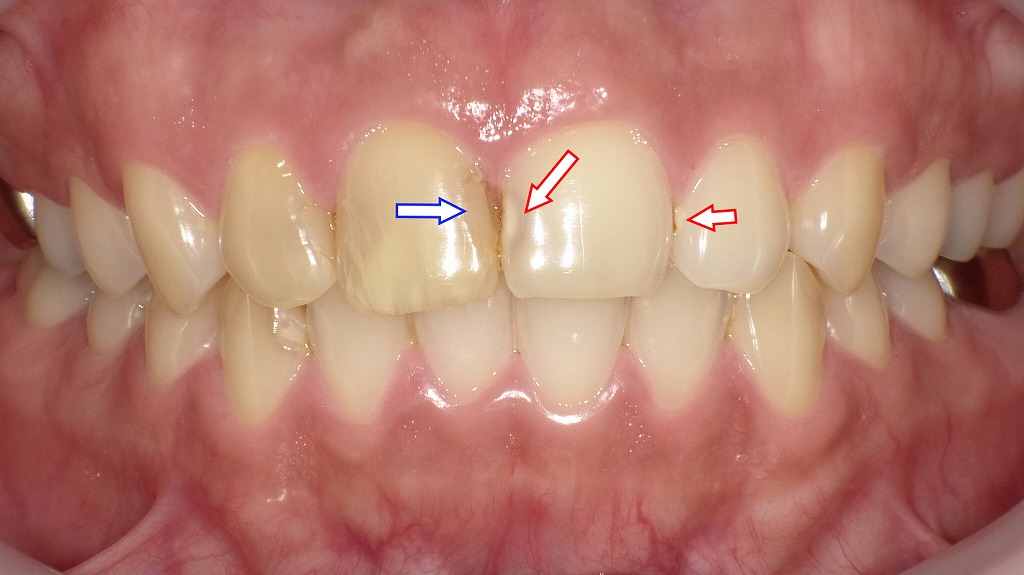 前歯の虫歯の症例２