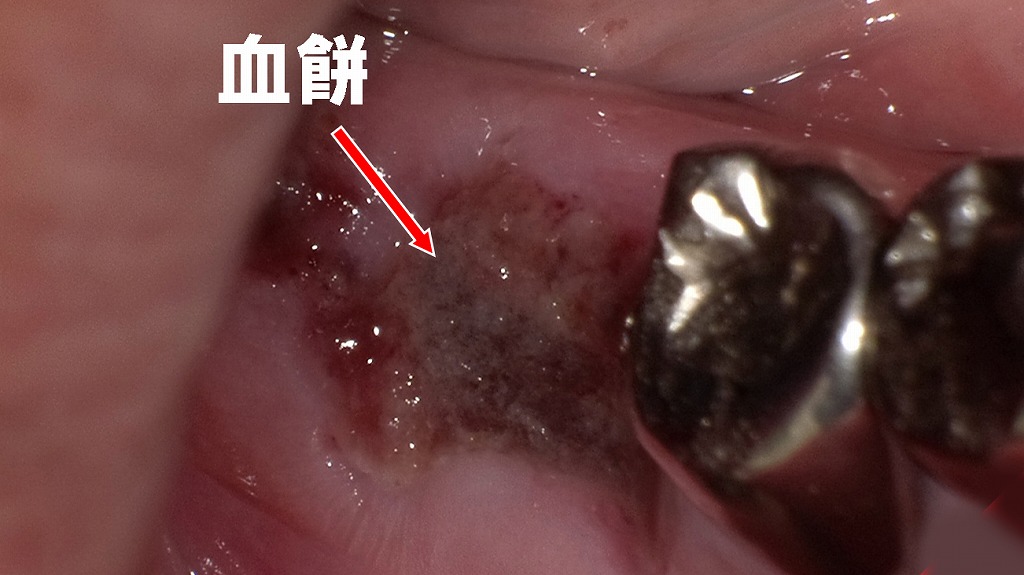 出血が続くときの原因は血餅にあり？抜歯後の正常経過を写真で説明
