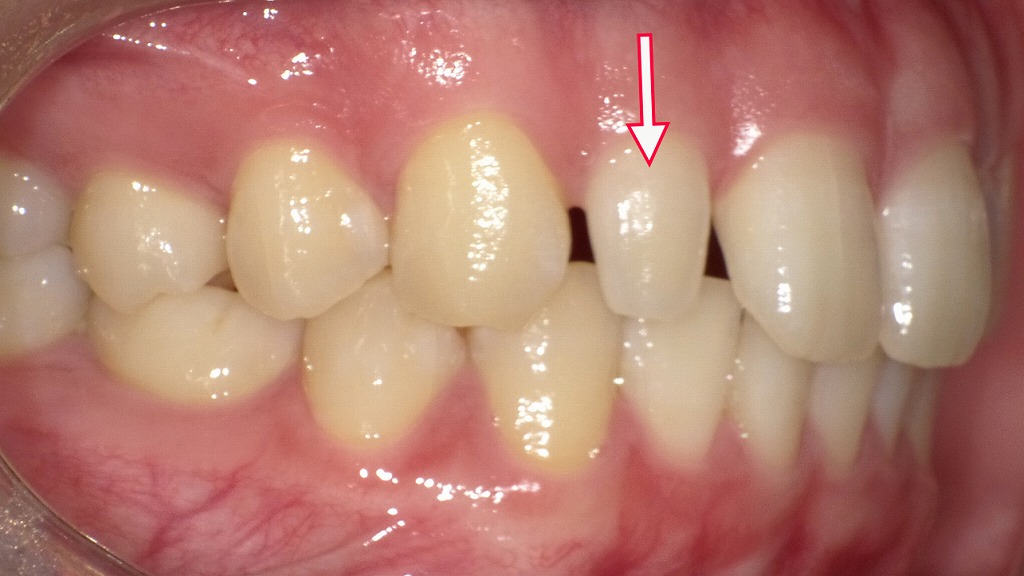 右上顎側切歯が矮小歯