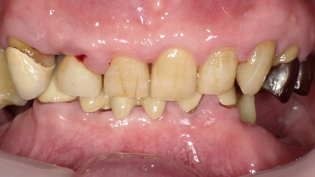 症例3：大人（永久歯）の過蓋咬合