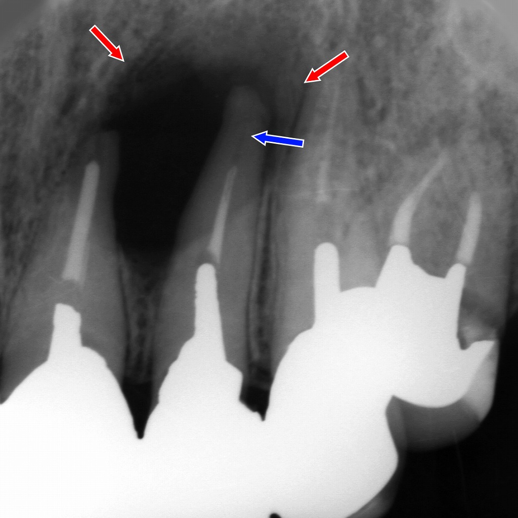 根管治療が失敗したケースのレントゲン解説（上顎2番が原因歯）
