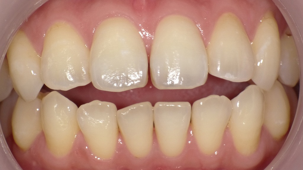 2枚目（ホワイトニング後）