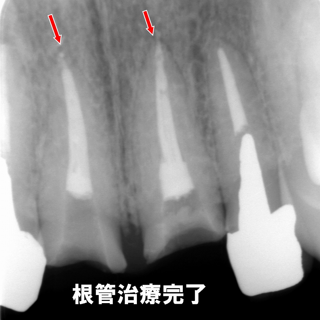 太くて真っすぐな前歯の根管 — スムーズに治療が完了したケース