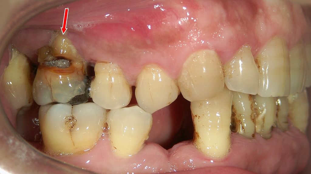 重度の歯周炎により歯肉が大きく腫れ、歯根面に強い汚れと炎症が認められる状態。深い歯周ポケット内に感染組織が残存している。