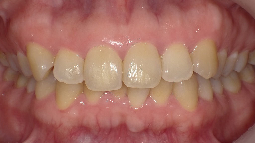 1枚目：ホワイトニング前（歯が黄ばみ気味）