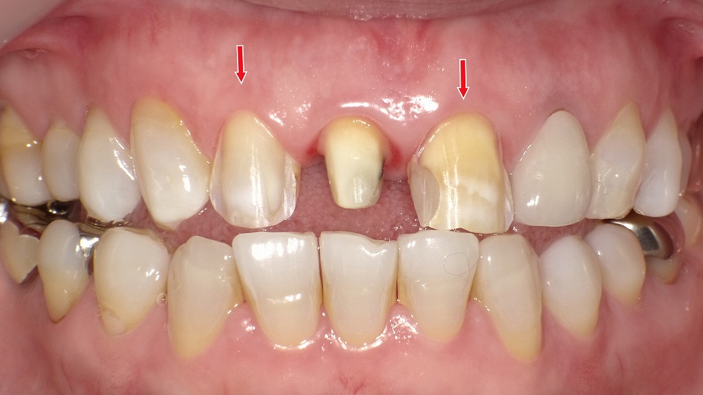 変色・欠損した前歯を、ラミネートべニアとセラミッククラウン、ファイバーコアを組み合わせて審美的に修復する治療計画です。