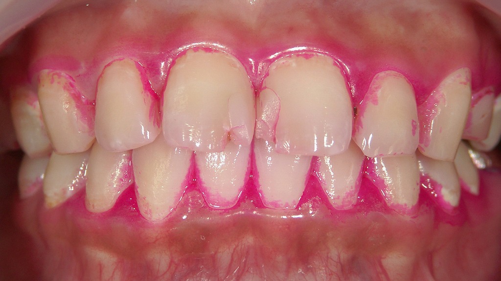 歯磨き指導後の変化：磨き残しの減少と清掃効率の向上