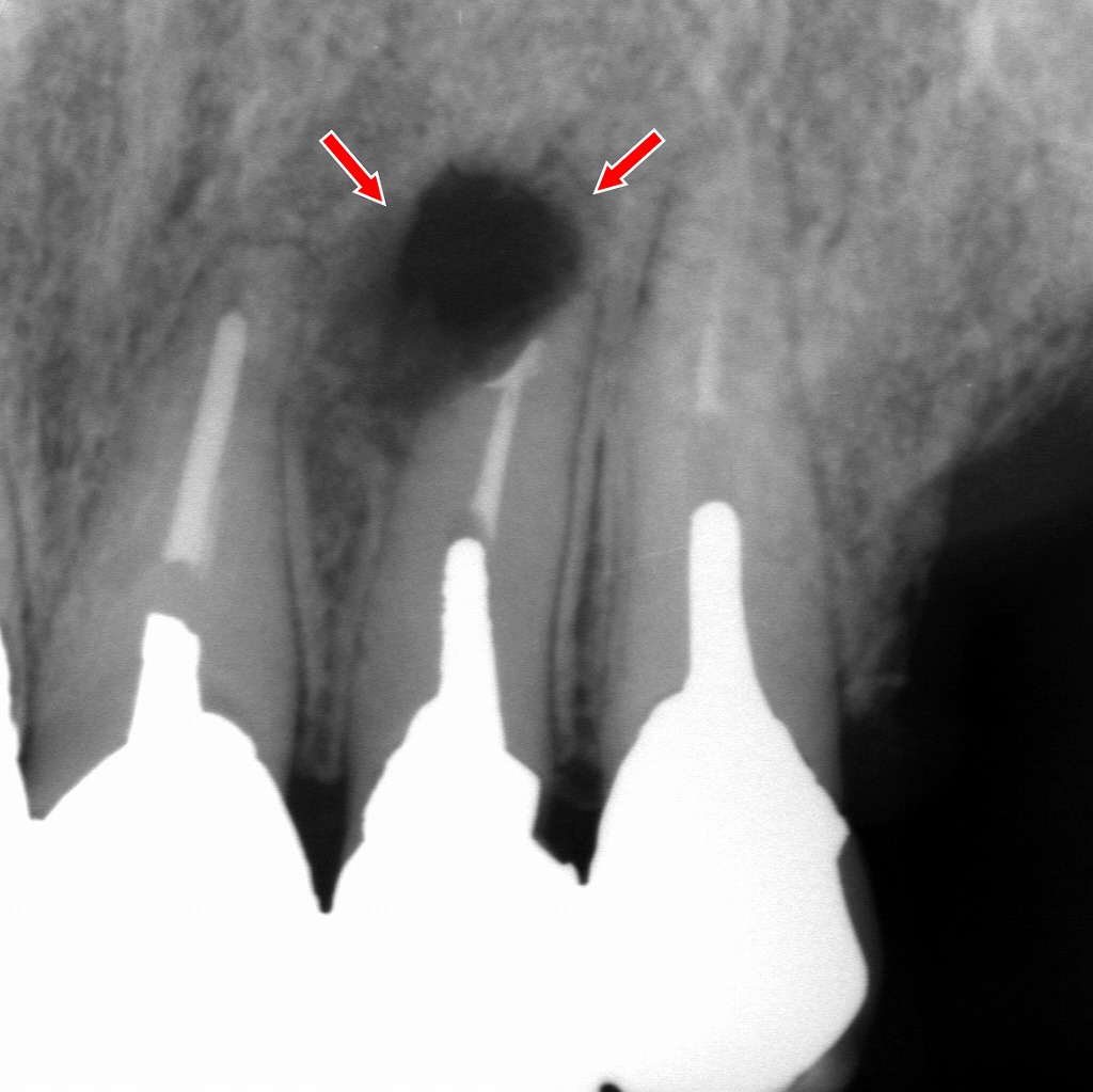 同症例の経過観察：3か月後の根尖病巣の縮小
