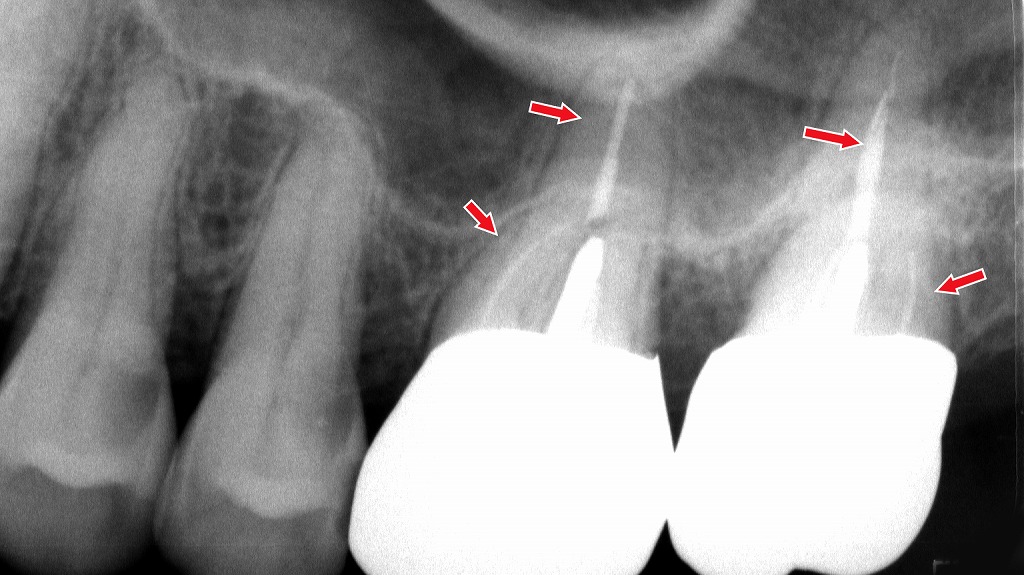 歯が浮くように感じる原因|神経の炎症と根管治療が必要なケース