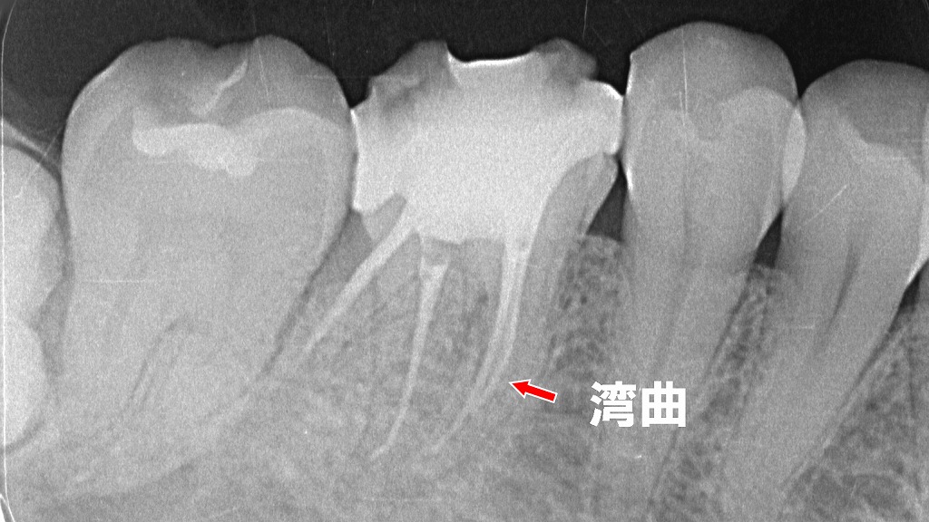強く湾曲した大臼歯の根管 — 根管治療が難しくなる典型例
