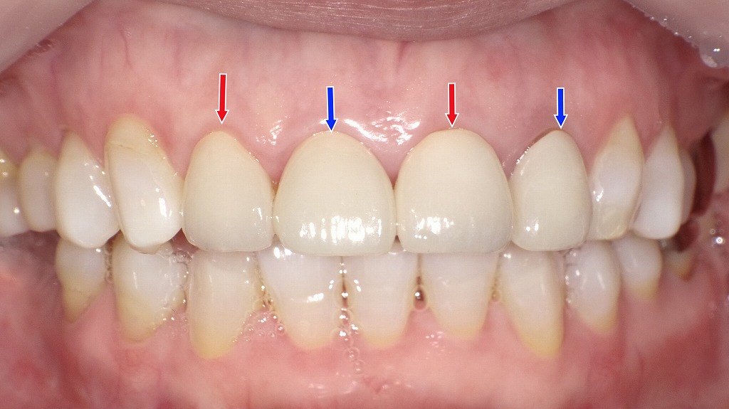 前歯の審美修復が完了し、自然で調和のとれたスマイルラインに改善されました。