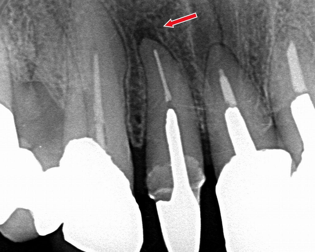 歯が浮く感覚の正体──上顎4番に生じた根尖病変が原因のことも
