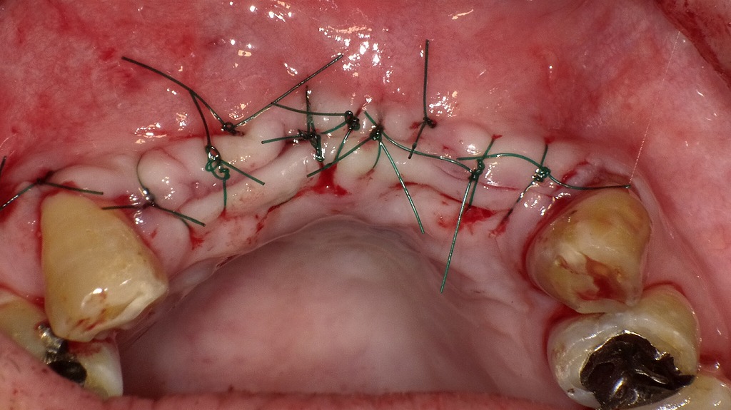 インプラント一次手術後の縫合法。治癒を待ち、次段階の二次オペでアバットメント装着を予定しています。