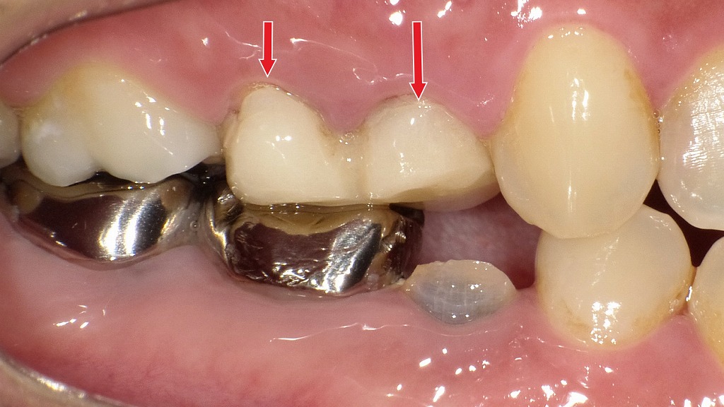 治療途中の仮歯を装着した状態