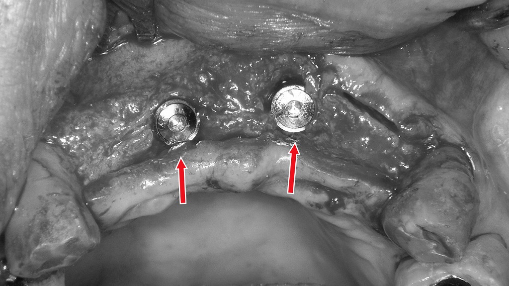 骨の治癒後、適切な位置にインプラントを埋入した術中所見。