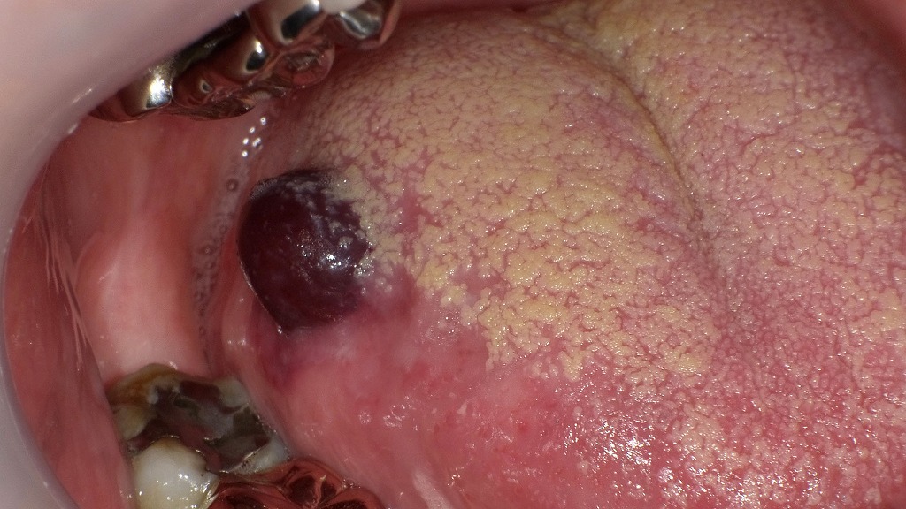 舌にできた血豆（口腔内血腫）―発症時の所見