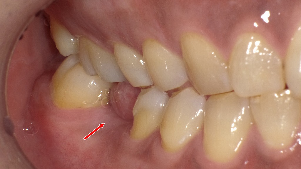 下顎6番欠損:インプラントとの比較