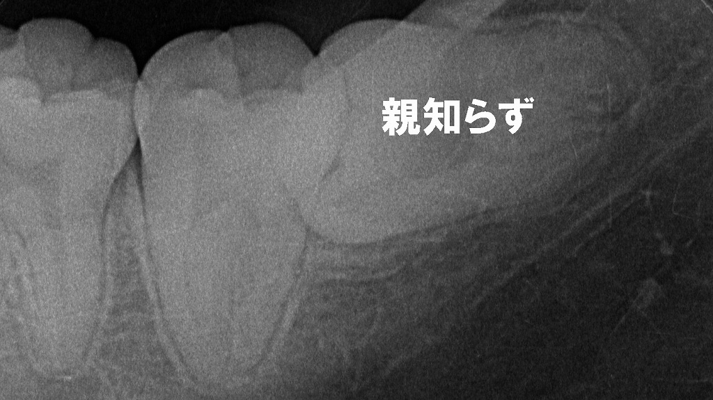 歯がむずむずする原因は?奥で押している親知らずのサイン