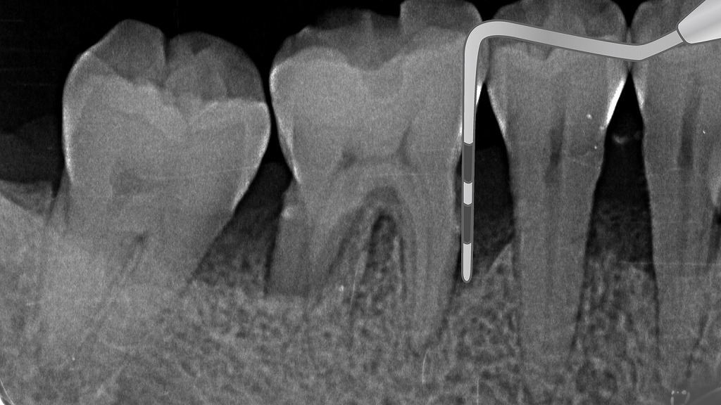 重度歯周病のプロービング所見