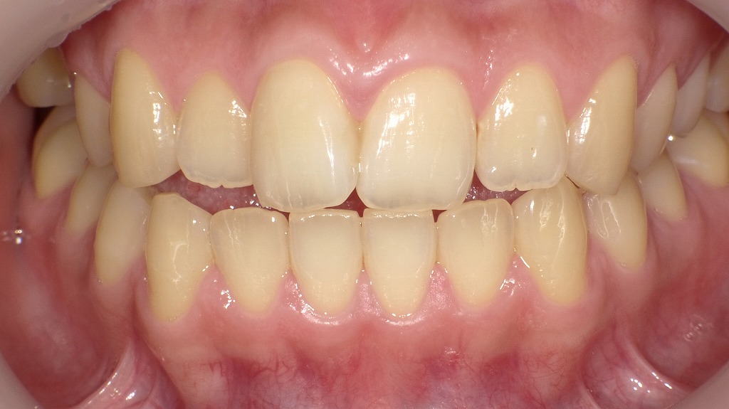 切端咬合のため上下の歯に隙間が出来ています