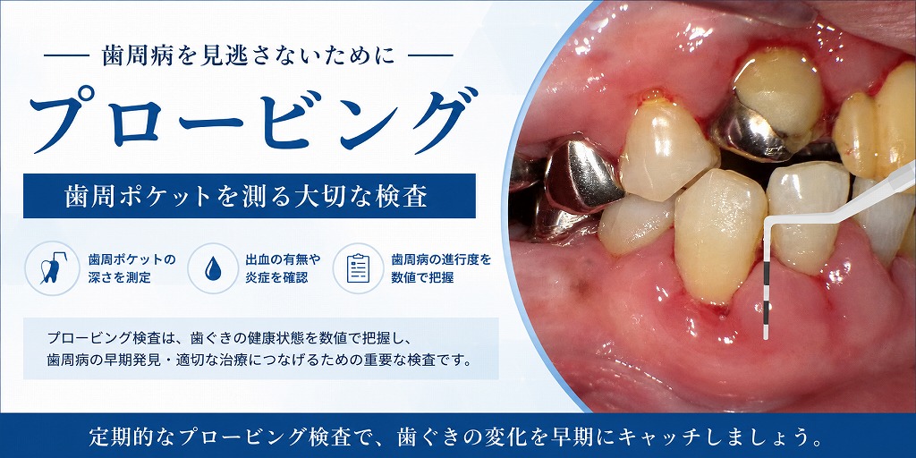 プロービングとは