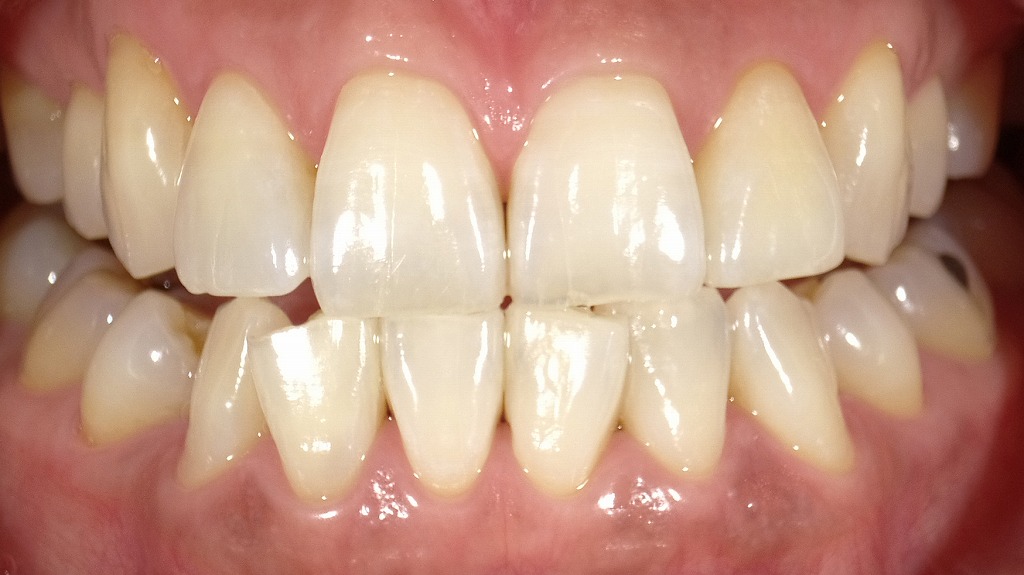 ホワイトニング後（2枚目）