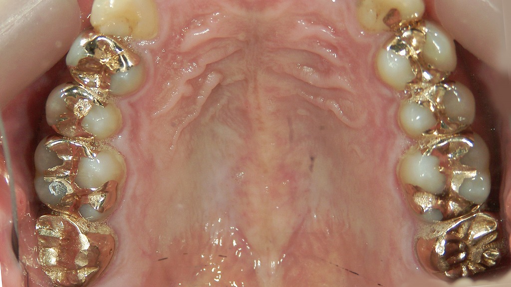 奥歯の虫歯の治療例